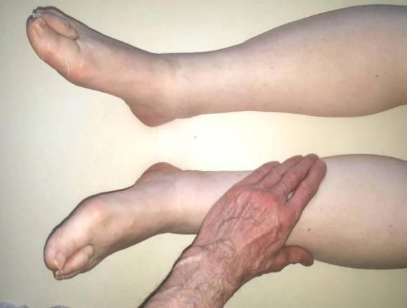 Gesundheitstipp der Woche · Lymphdrainage bei "dicken" Beinen